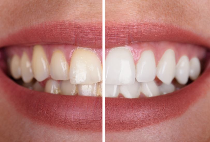 Teeth Whitening Preston Chorley Tarleton Dentist