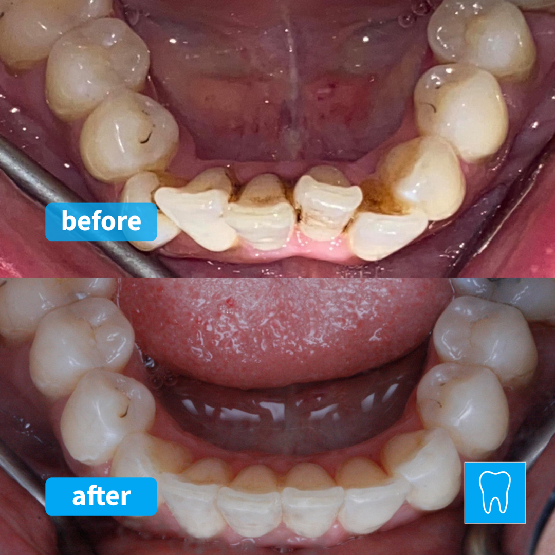 Invisalign Teeth Straightening Dental Treatment Whitby Scarborough North Yorkshire